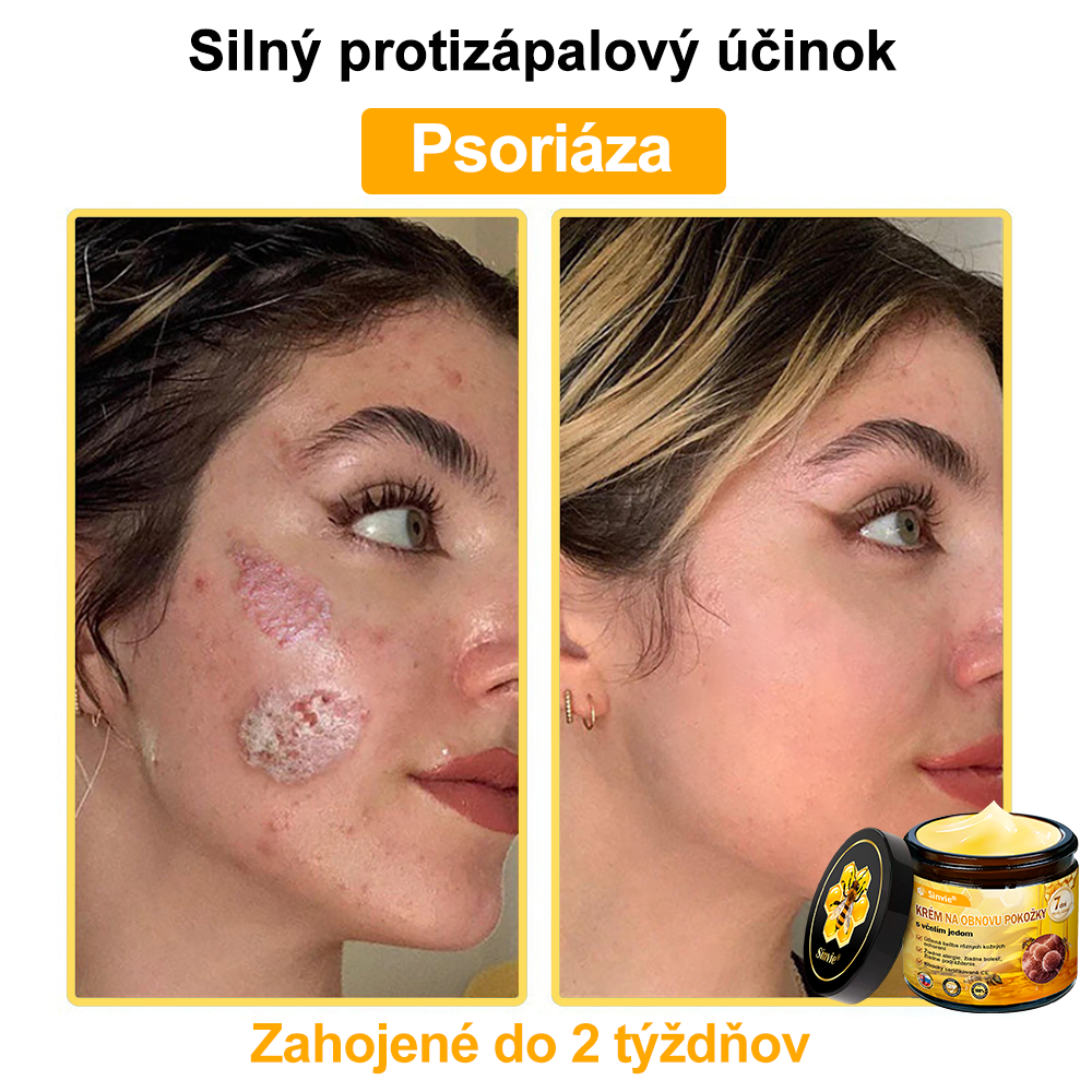 ☁️☁️☁️Sinvie® regeneračný krém s včelím jedom | 50 ml | Odporúčaný Slovenskou dermatovenerologickou spoločnosťou